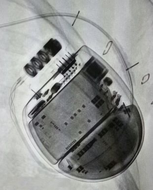 Implanten un desfibril·lador automàtic cardíac per primer cop a les comarques gironines