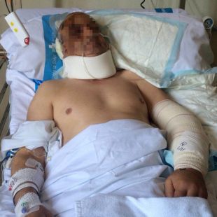 Veïns de l’home atacat per dos pitbulls reclamen que els gossos tornin a la protectora de Figueres