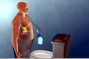 La Clínica Girona fa una operació pionera a la ciutat per tractar l'obesitat mòrbida