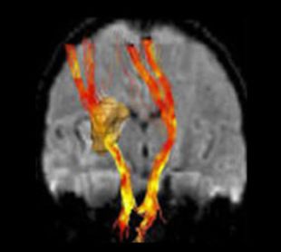 Troben un mètode que permet predir l'evolució dels pacients que han patit un infart cerebral 