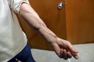 Arriba a judici el cas dels dos pit bull que van atacar un veí de Llagostera