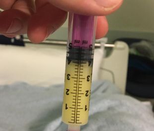 L'hospital d'Olot posa en marxa un protocol d'extracció de calostre abans del part