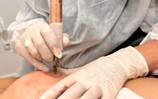 L'hospital de Palamós implementa la micropigmentació del mugró a dones que han patit càncer de mama