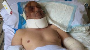 El veí de Llagostera ferit, encara a l'hospital Josep Trueta © ACN