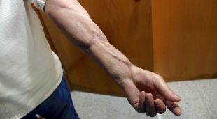 Un dels gossos va mossegar el braç esquerre de la víctima, li va arrencar la carn i li ha deixat la mà pràcticament inutilitzada