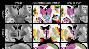 MRI d'un cervell inclòs en l'estudi