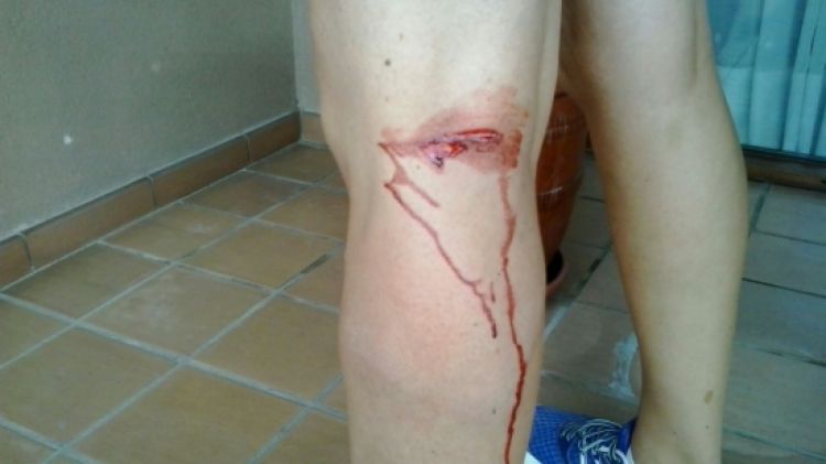 La ferida que els gossos van provocar-li a la cama esquerra © ACN