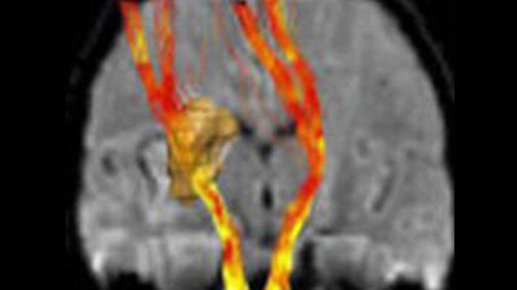 Les vies principals que regeixen la mobilitat dels membres, afectades -sovint- pels infarts cerebrals © ACN