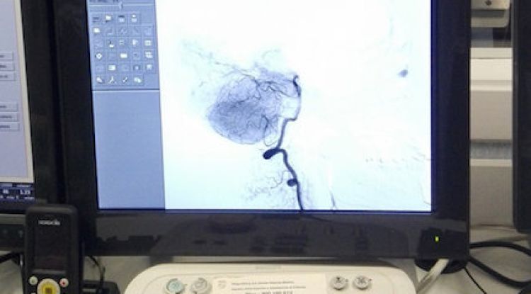 Una imatge de la prova diagnòstica per saber les causes dels ictus que el Trueta ha començat a realitzar