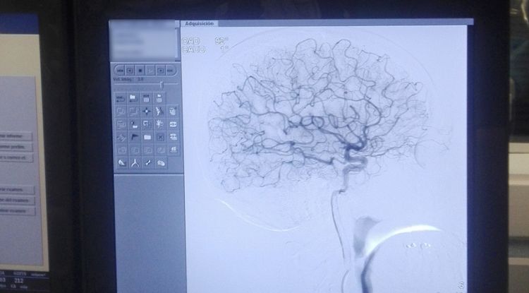 Una angiografia cerebral amb el quiròfan de fons