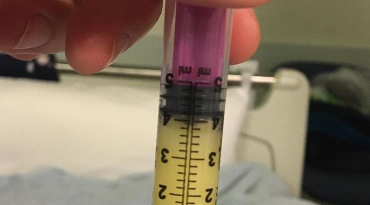 Pla detall de calostre extret a l'hospital d'Olot