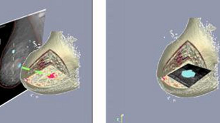 Exemple d'integració de diferents modalitats d'imatge per la millora en la detecció del càncer de mama © ACN