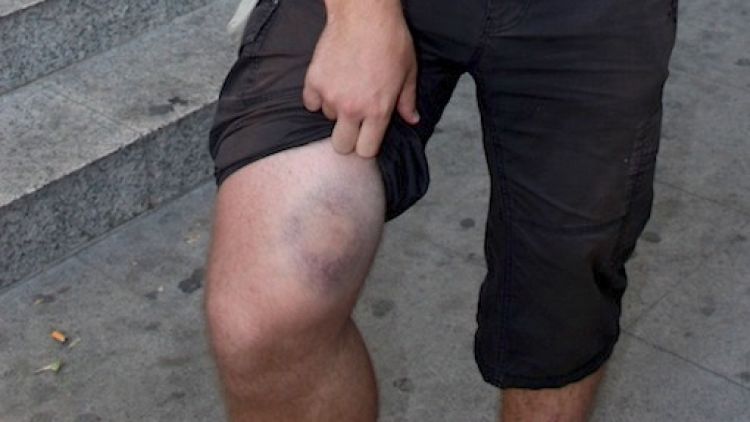 El militant de la CUP mostra les ferides que va patir (arxiu)