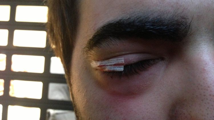 El jove ferit a l'ull, Jordi Alemany, ha necessitat atenció mèdica després del cop de porra © ACN
